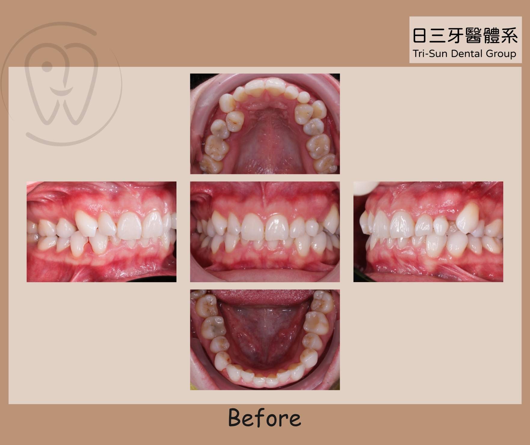 牙齒排列整齊 告別齒縫藏汙納垢 牙齒排列整齊 告別齒縫藏汙納垢