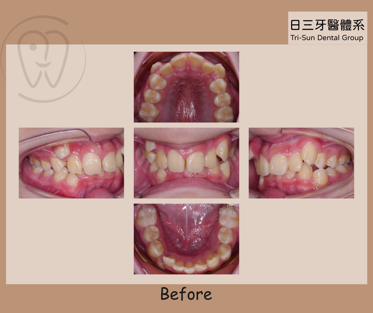 告別擁擠牙齒 笑容從「齒」綻放 告別擁擠牙齒 笑容從「齒」綻放