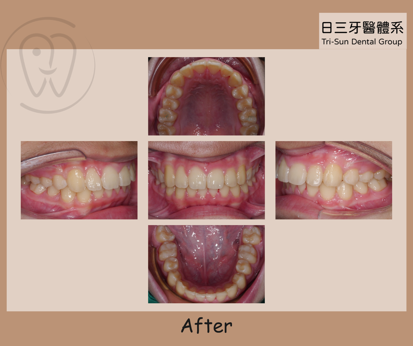 告別擁擠牙齒 笑容從「齒」綻放 告別擁擠牙齒 笑容從「齒」綻放