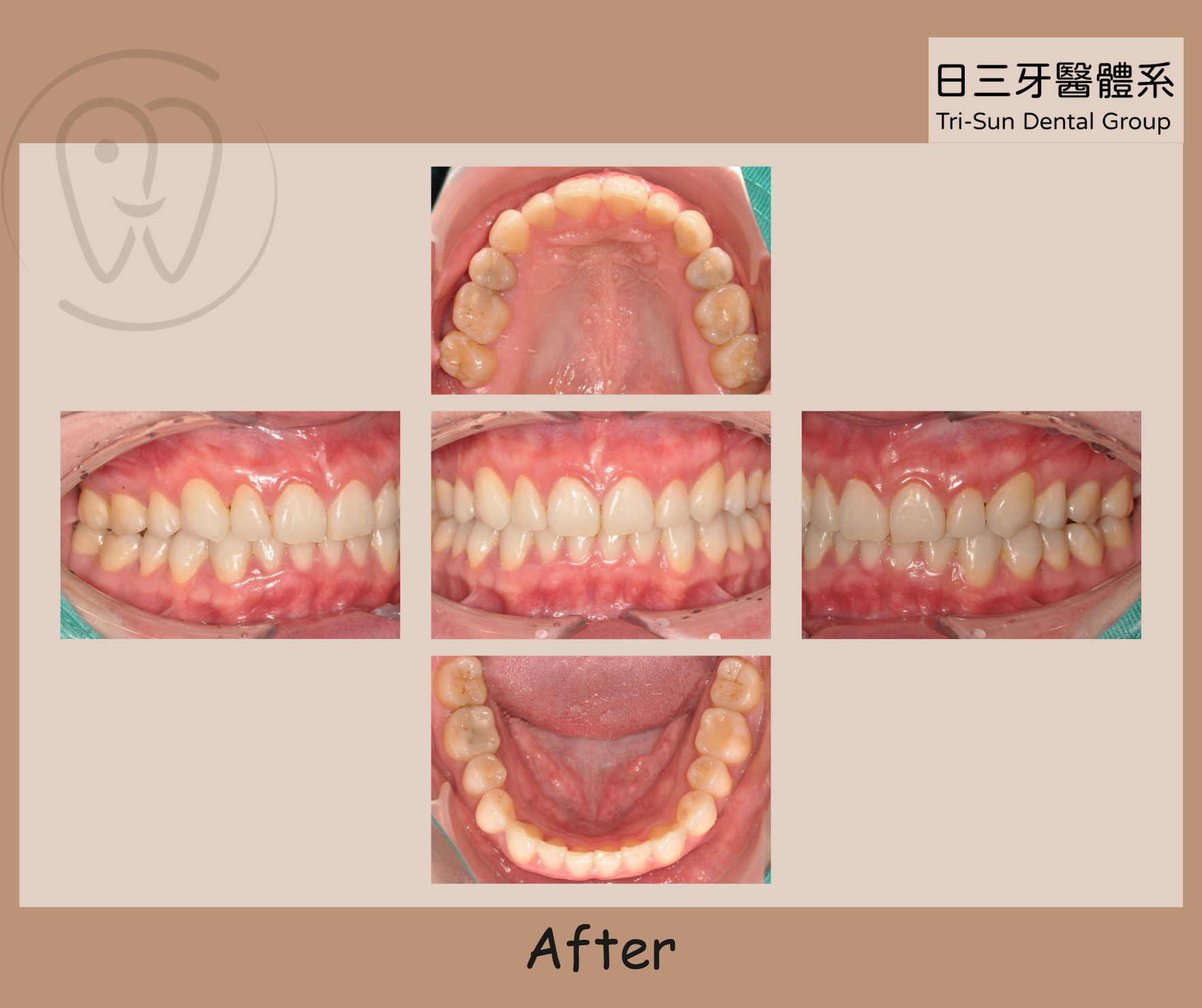牙齒排列整齊 告別齒縫藏汙納垢 牙齒排列整齊 告別齒縫藏汙納垢