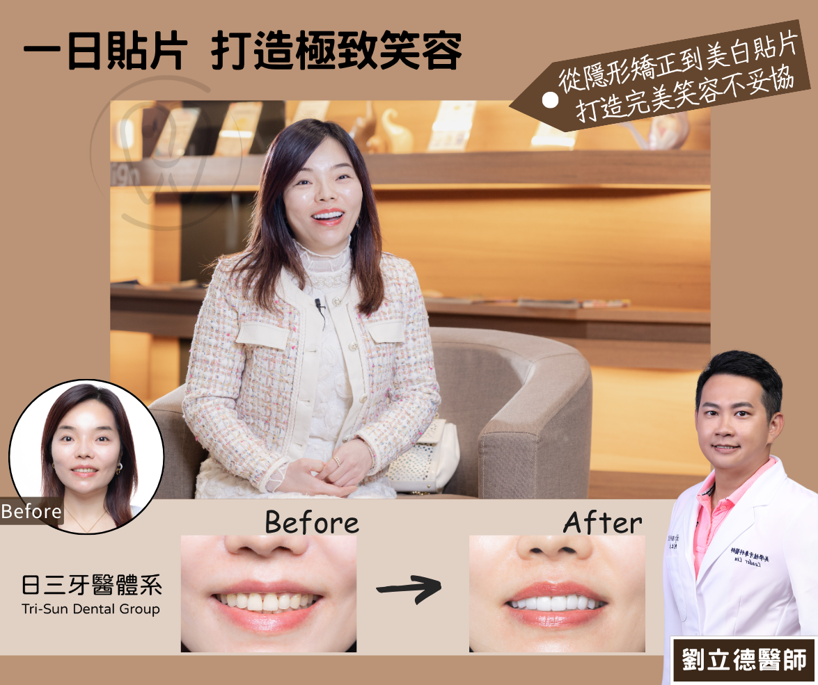 從矯正到貼片 完美笑容不妥協 從矯正到貼片 完美笑容不妥協