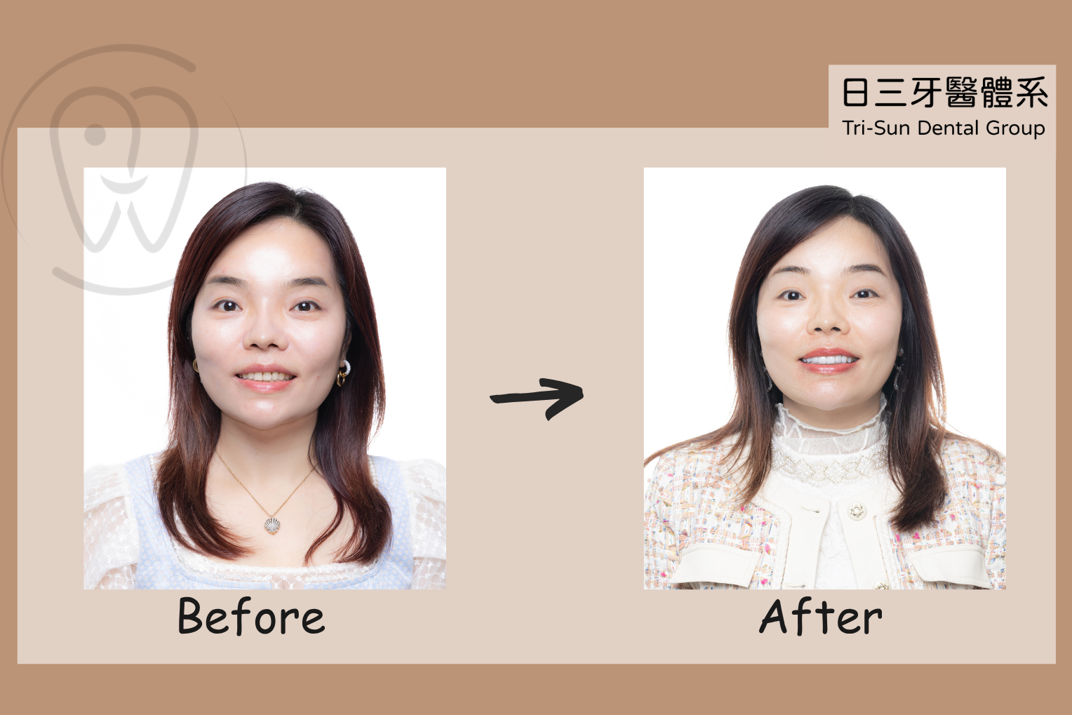 從矯正到貼片 完美笑容不妥協 從矯正到貼片 完美笑容不妥協