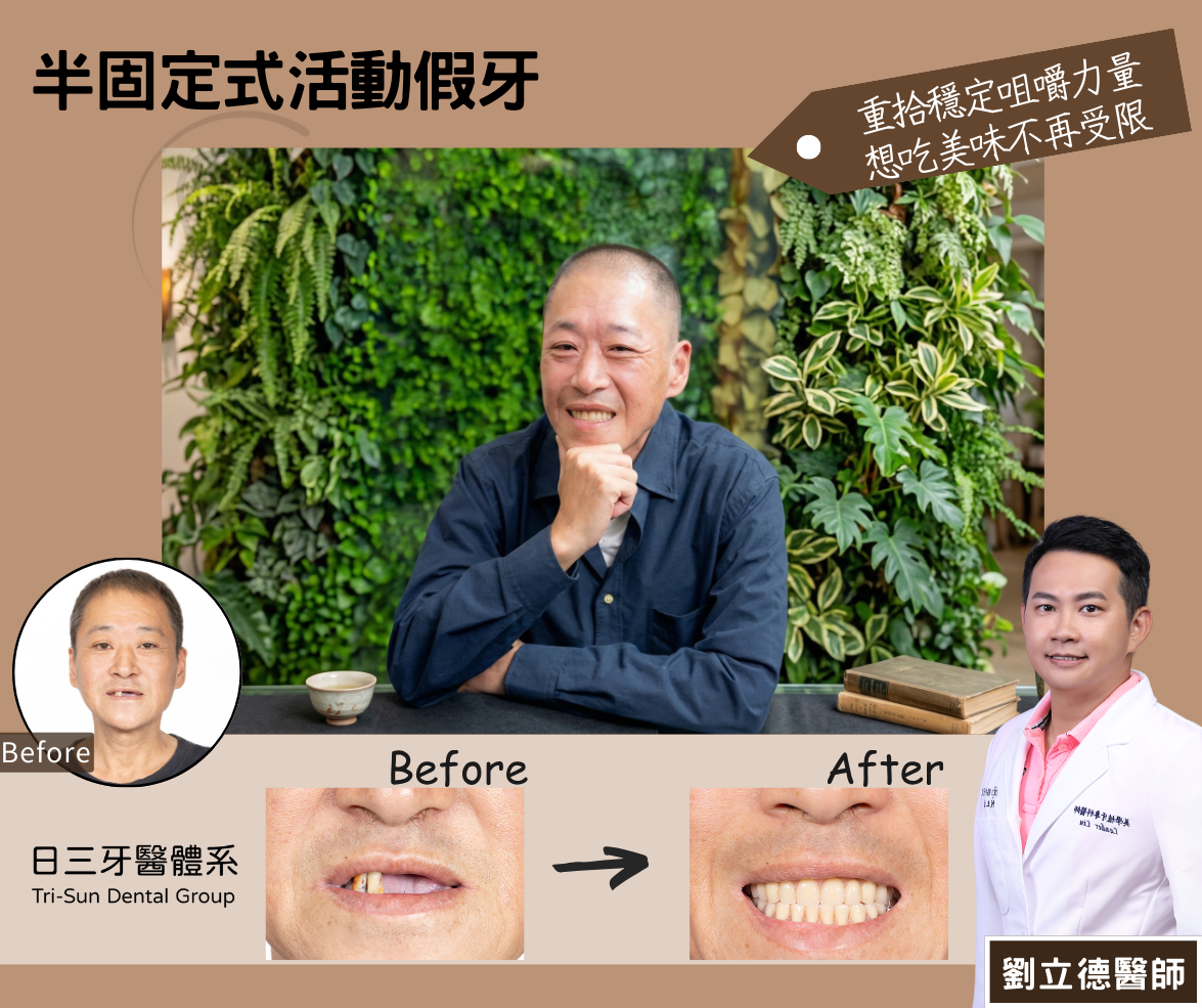 重拾穩定咀嚼力 想吃美味不受限 重拾穩定咀嚼力 想吃美味不受限