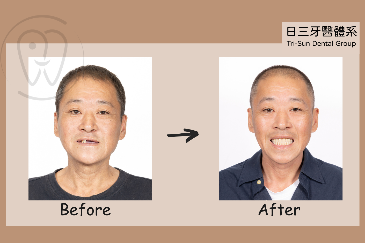 重拾穩定咀嚼力 想吃美味不受限 重拾穩定咀嚼力 想吃美味不受限