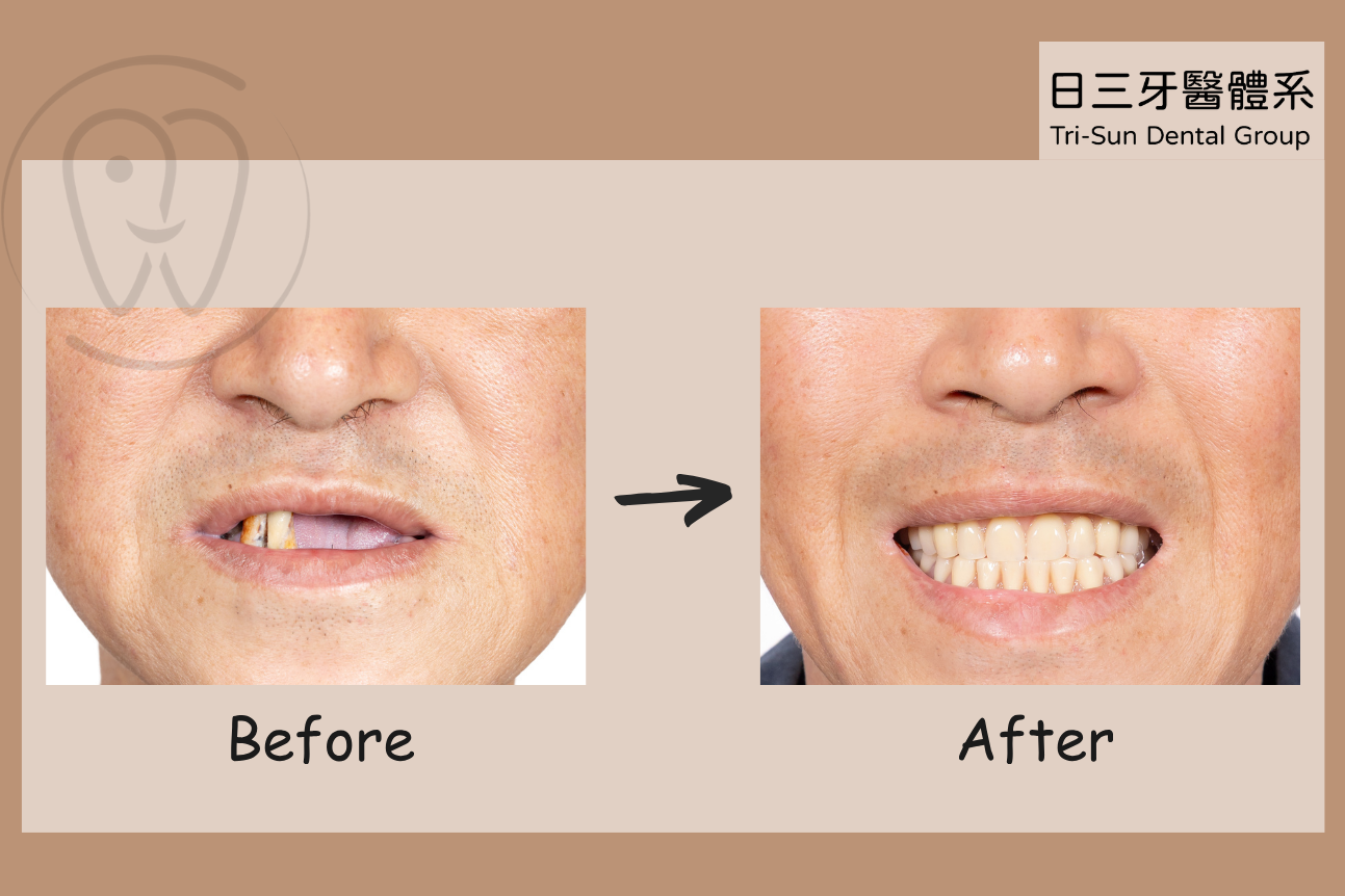 重拾穩定咀嚼力 想吃美味不受限 重拾穩定咀嚼力 想吃美味不受限