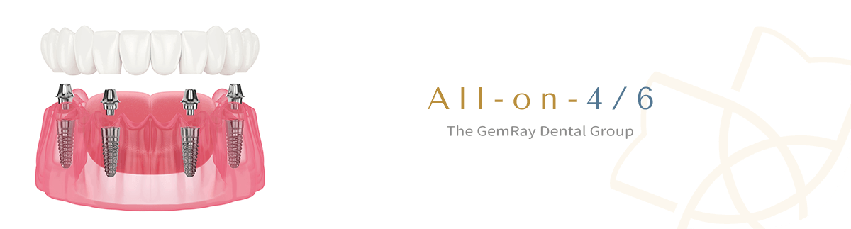 All-on-4/6 植牙 All-on-4/6 植牙